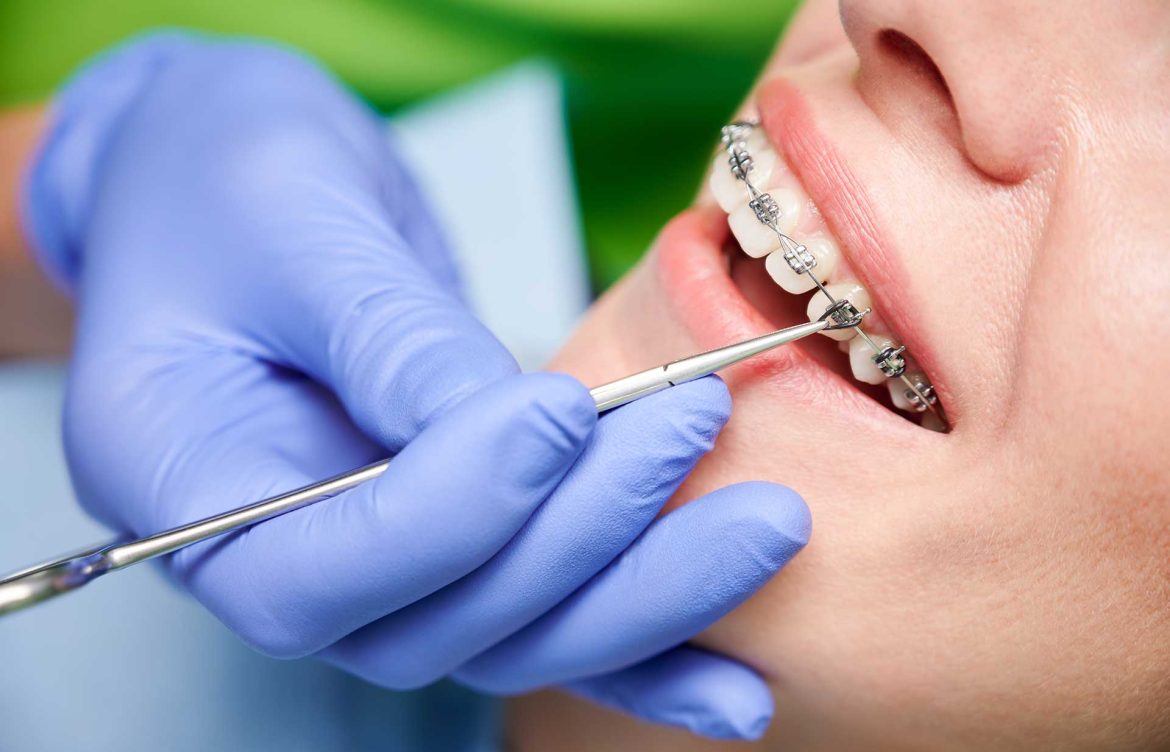 Perfect Dental Alignment Secured Through High Quality Metallic Braces Treatment