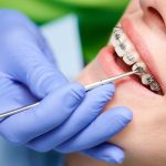 Braces Treatment