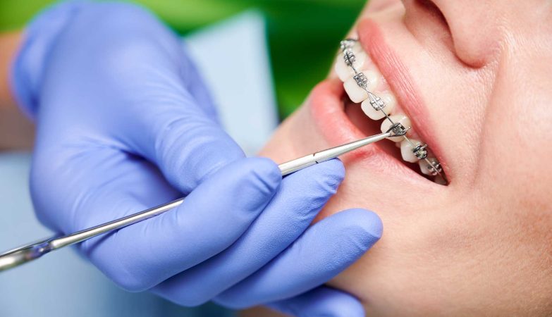 Braces Treatment