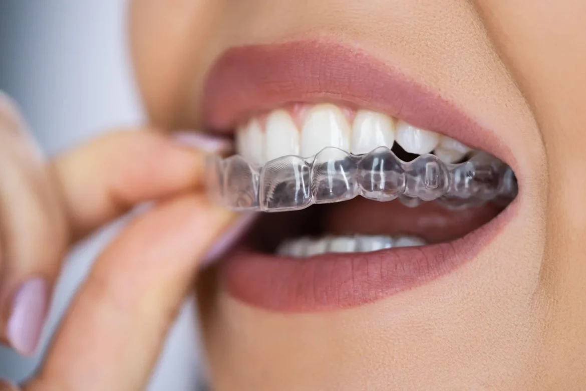 How Invisalign Affects Your Gum Health Throughout Orthodontic Treatment