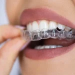 How Invisalign Affects Your Gum Health Throughout Orthodontic Treatment